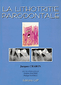 La lithotritie parodontale - J.CHARON