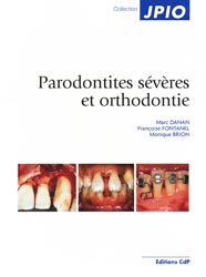 Parodonties sévères et orthodontie - Marc DANAN, Françoise FONTANEL, Monique BRION