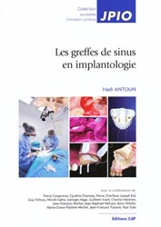 Les greffes de sinus en implantologie - Hadi ANTOUN