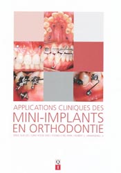 Applications cliniques des mini-implants en orthodontie - J-S.LEE - QUINTESSENCE INTERNATIONAL - 