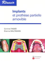 Implants et prothèse partielle amovible - Corinne TADDÉI, Étienne WALTMANN